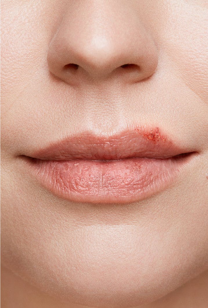 Cold sore healing stages with pictures zovirax au