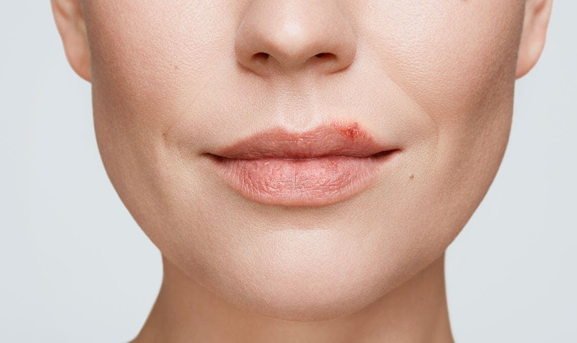 Cold Sore Healing Stages With Pictures Zovirax Au