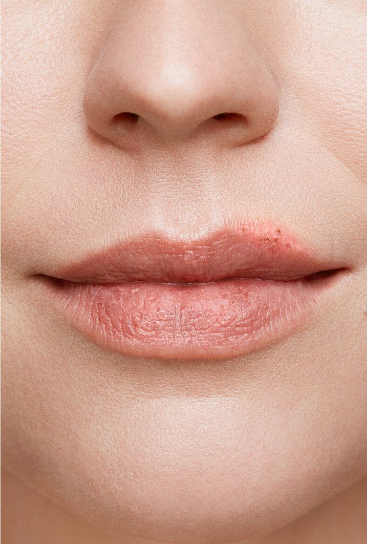Cold Sore Healing Stages With Pictures Zovirax AU