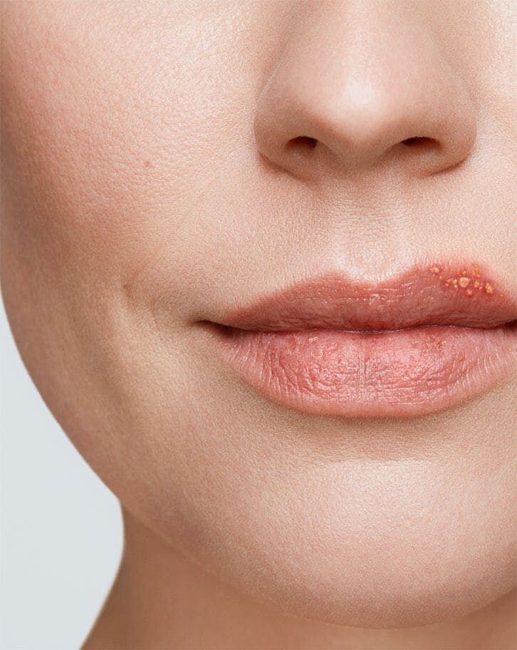 Cold Sore Stages Zovirax®