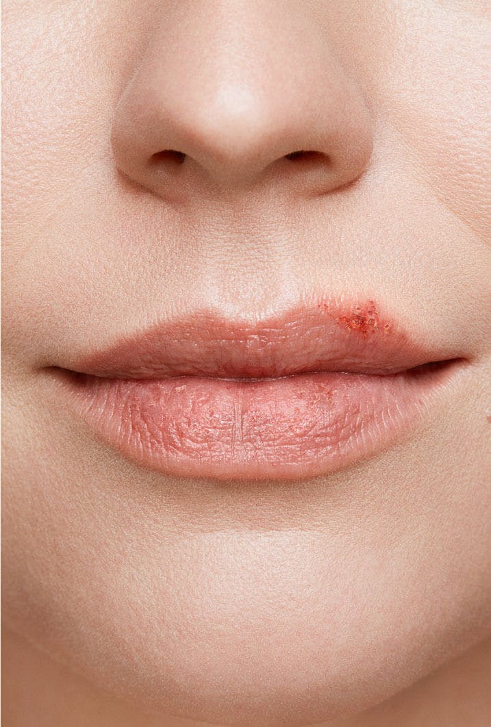 Cold Sore Stages Cold Sore Cycle Zovirax New Zealand