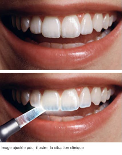 Les effets des attaques acides sur vos dents Les effets des attaques acides sur vos dents
